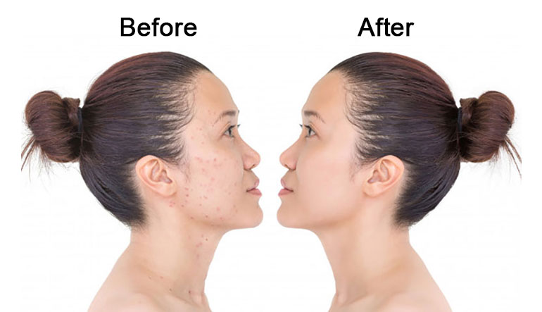 Anti Acne Detoxifying Facial
